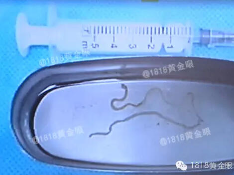 曼氏裂頭蚴寄生蟲(chóng)鉆入大腦：嘉興12歲女孩腦中取出20厘米寄生蟲(chóng)