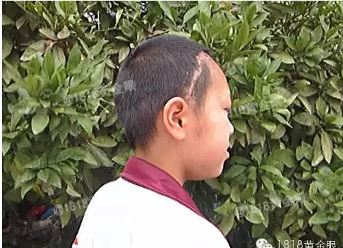 曼氏裂頭蚴寄生蟲(chóng)鉆入大腦：嘉興12歲女孩腦中取出20厘米寄生蟲(chóng)