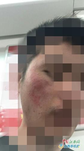 多名大學(xué)生毀容 都是因?yàn)榱淤|(zhì)的化妝品主辦方竟還稱是膚質(zhì)問題